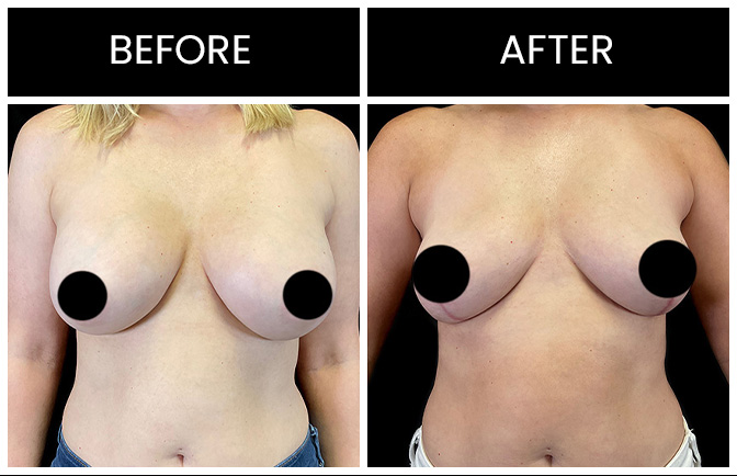 Breast Implant Removal Results Atlanta